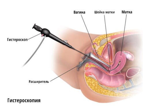 Процедура гистероскопии