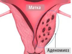 Что такое аденомиоз матки?